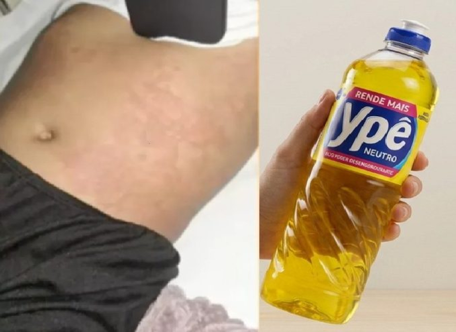 Infectologista descarta ligação entre detergente Ypê e lesões em criança internada no RN