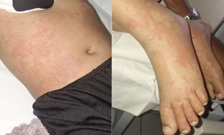 Exames descartam contaminação por detergente em menina internada no RN, diz Sesap